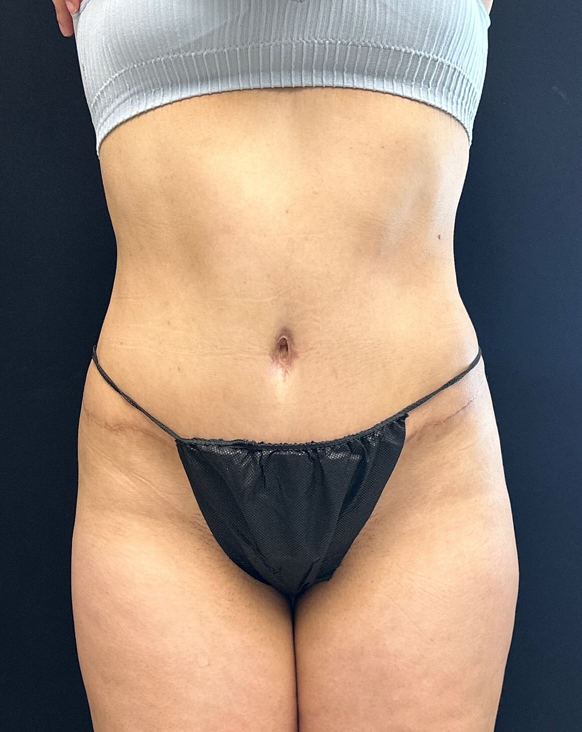 Tummy Tuck Before & After