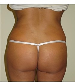 Brazilian Butt Lift Before & After