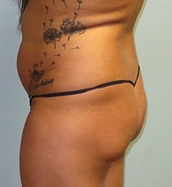 Brazilian Butt Lift Before & After