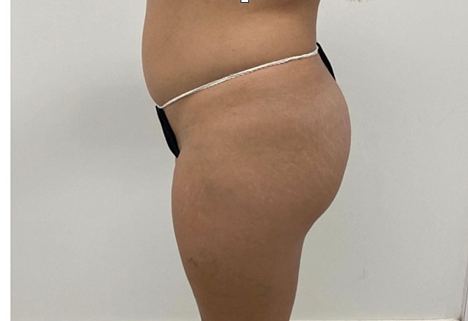 Brazilian Butt Lift Before & After