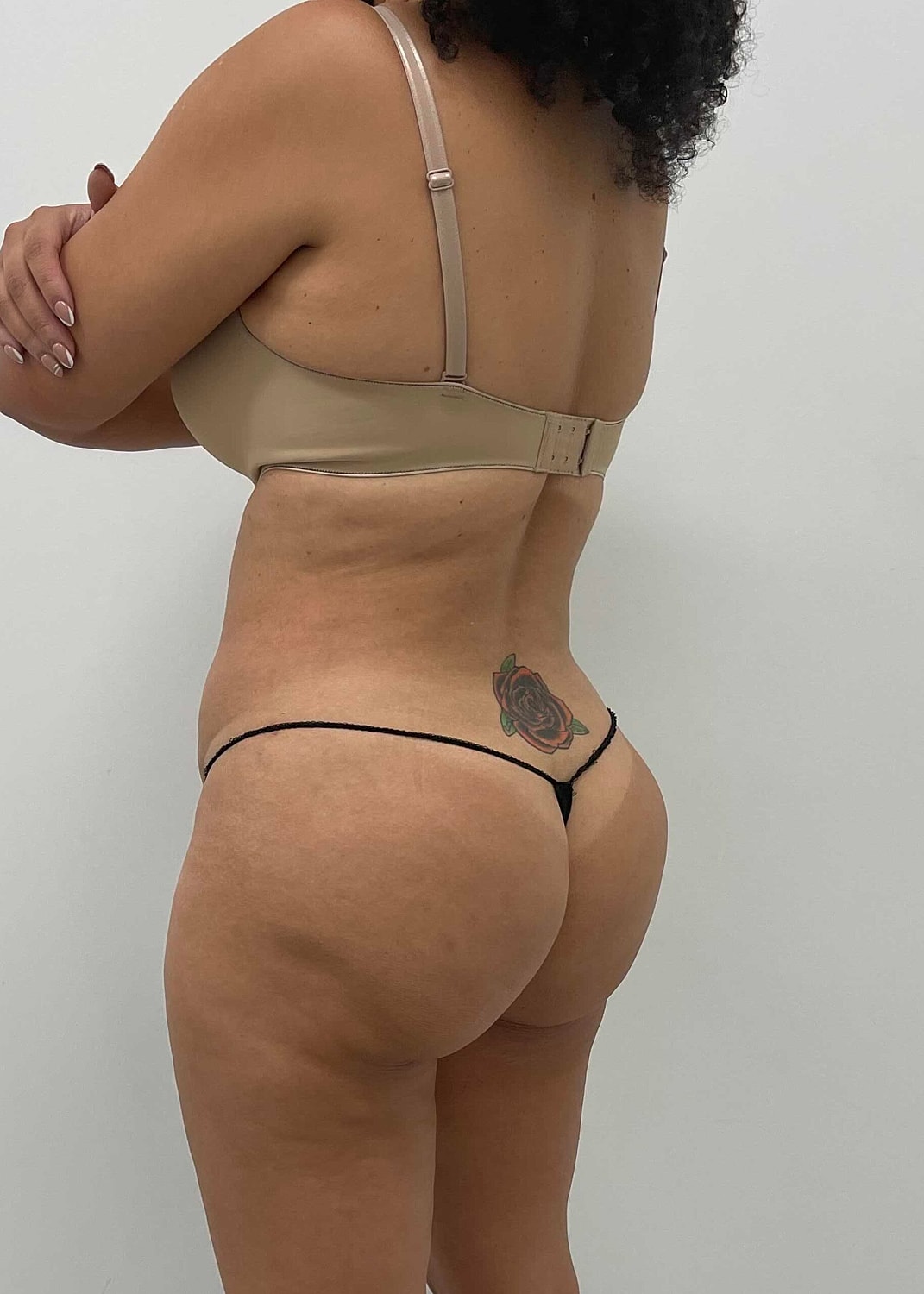 Brazilian Butt Lift Before & After
