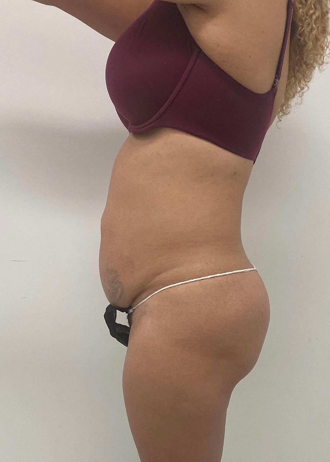 Brazilian Butt Lift Before & After