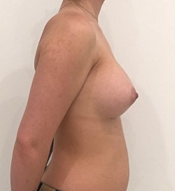 Breast Augmentation Before & After
