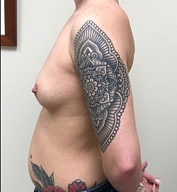 Breast Augmentation Before & After