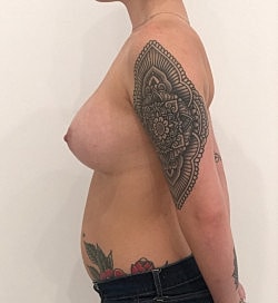 Breast Augmentation Before & After