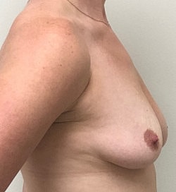 Breast Augmentation Before & After