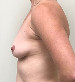 Breast Augmentation Before & After