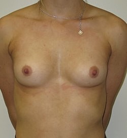 Breast Augmentation Before & After
