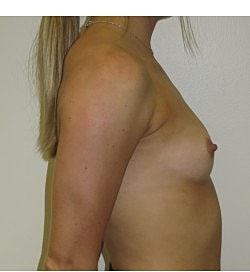 Breast Augmentation Before & After