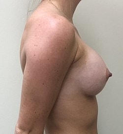 Breast Augmentation Before & After