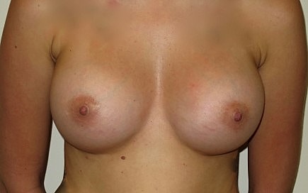 Breast Augmentation Before & After