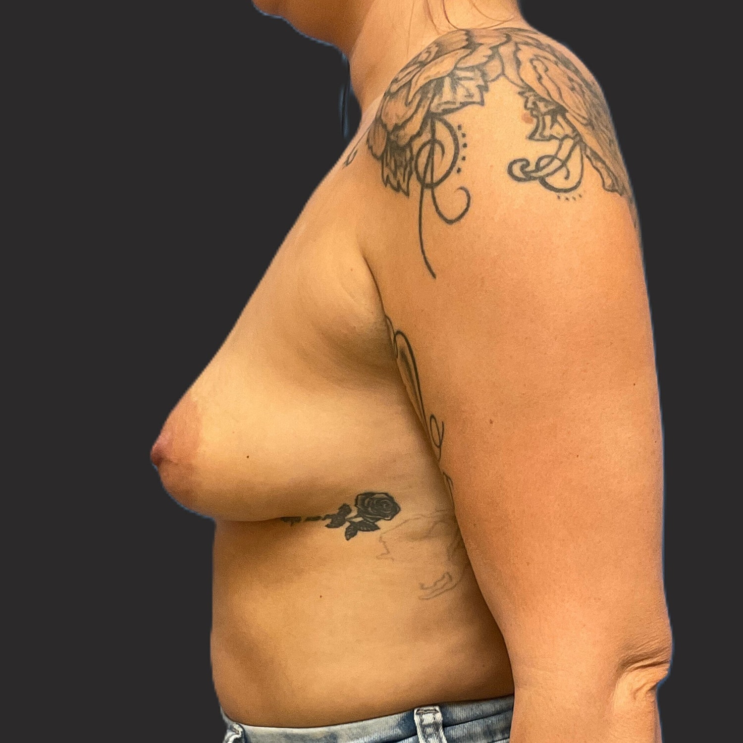 Breast Augmentation Before & After