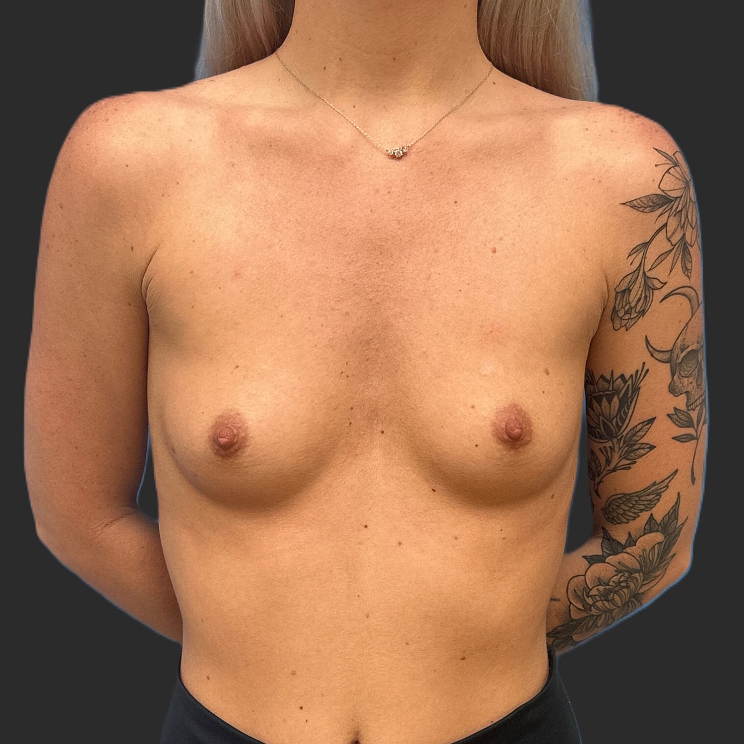 Breast Augmentation Before & After