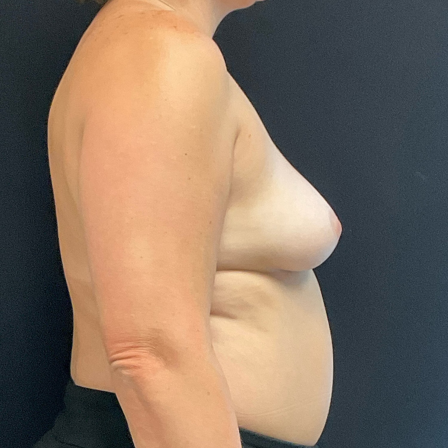 Breast Augmentation Before & After