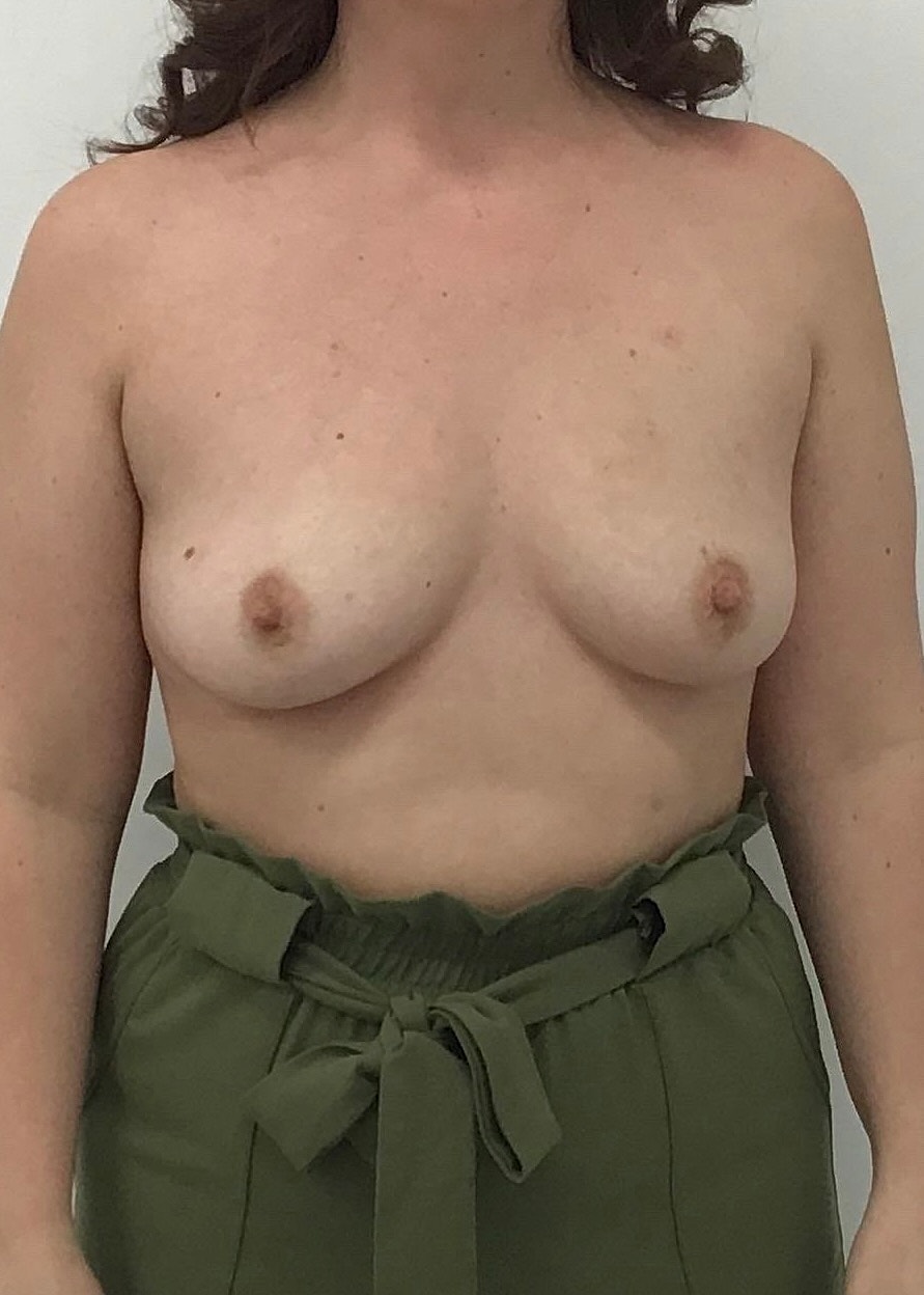 Breast Augmentation Before & After