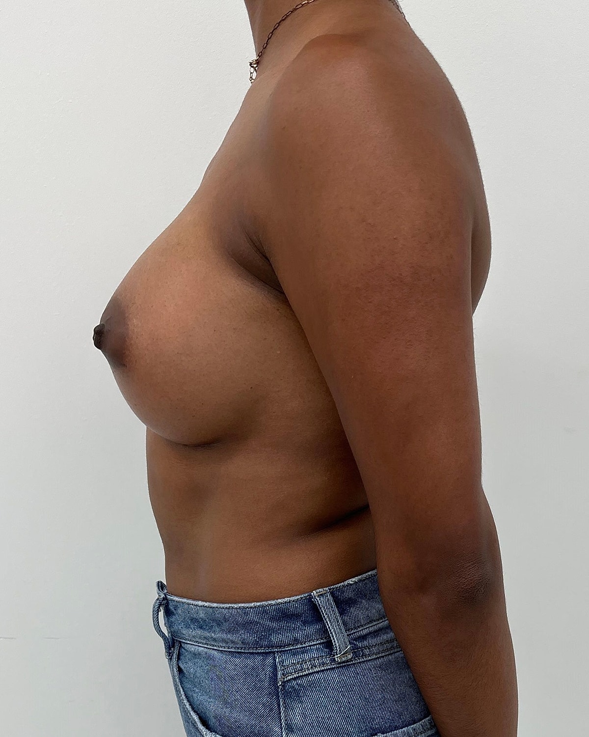 Breast Augmentation Before & After