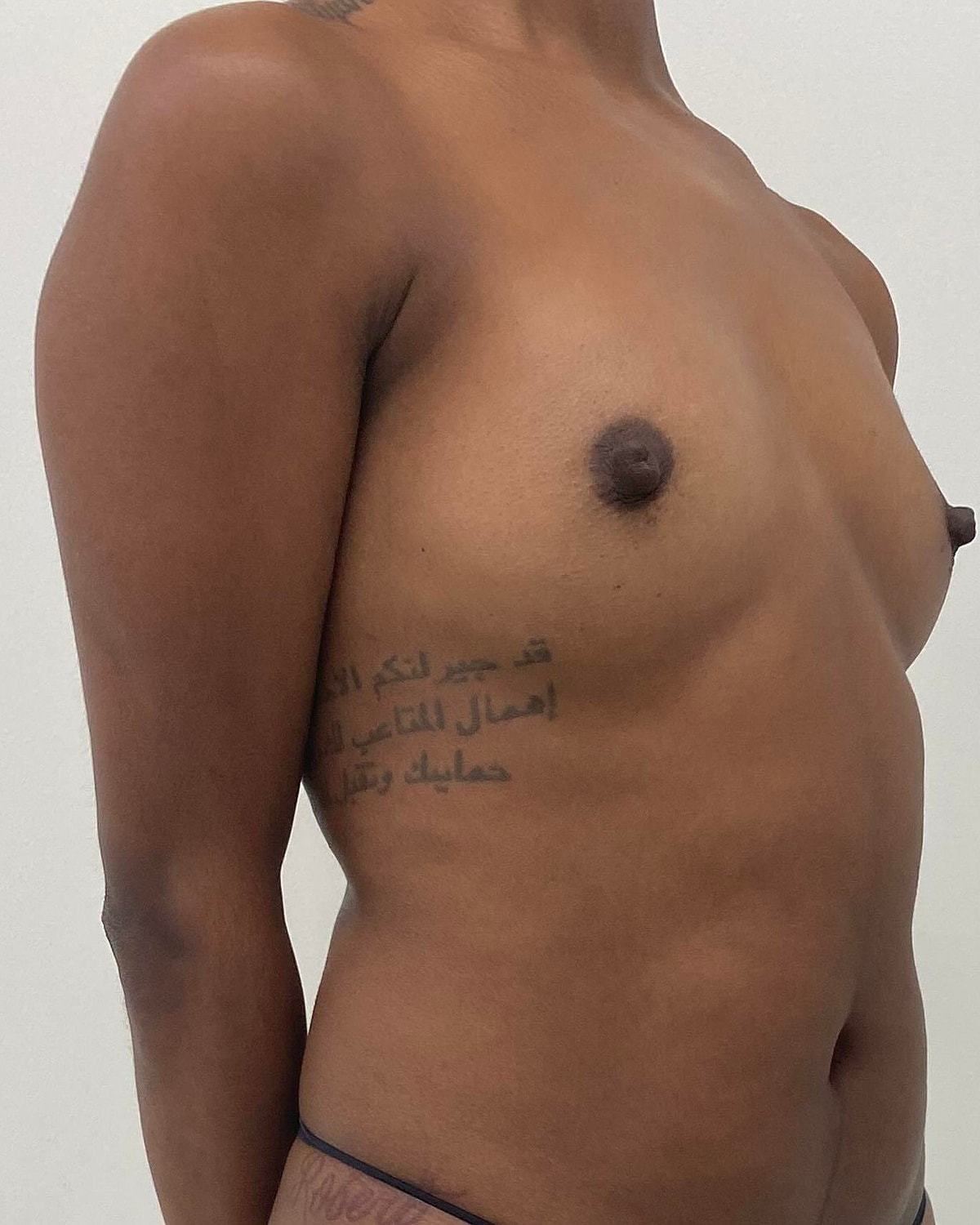 Breast Augmentation Before & After