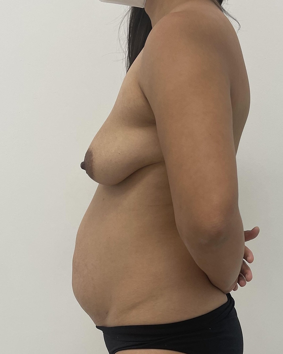 Breast Augmentation Before & After