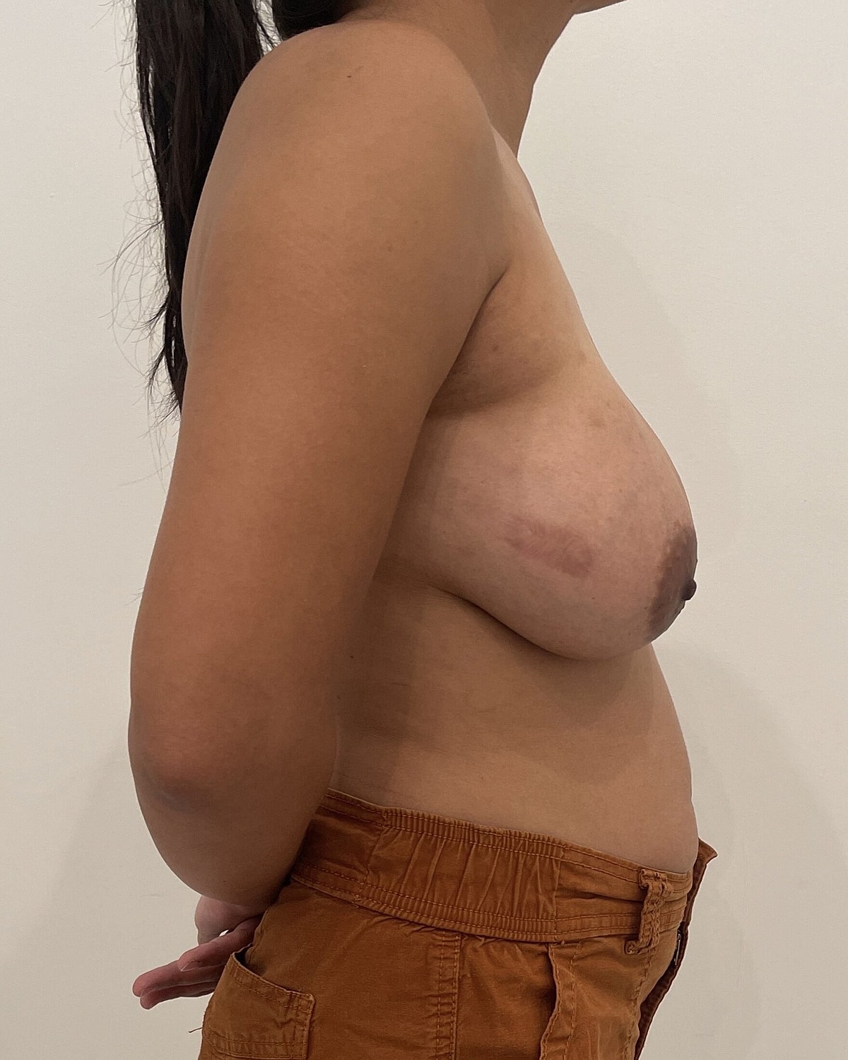 Breast Augmentation Before & After