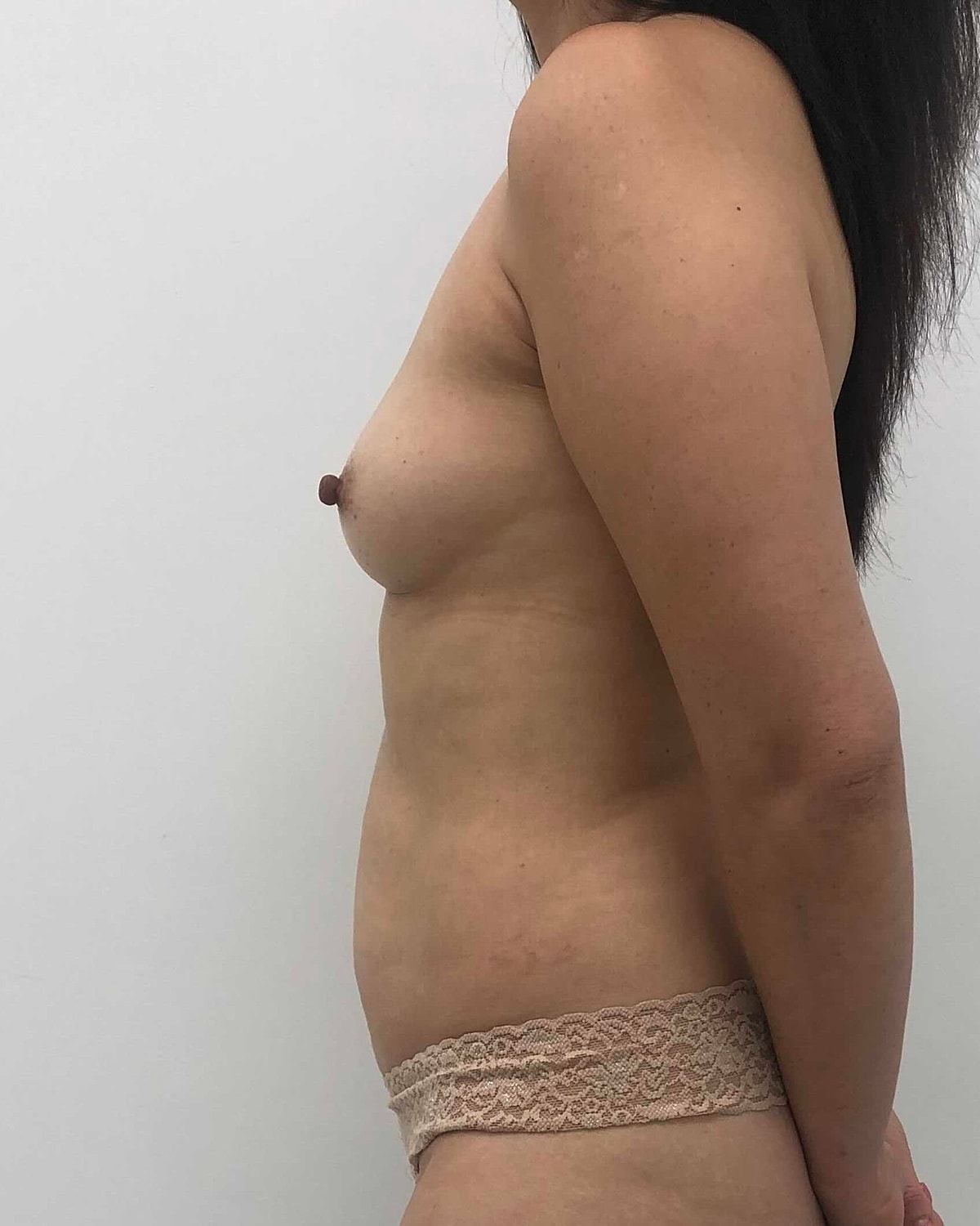 Breast Augmentation Before & After