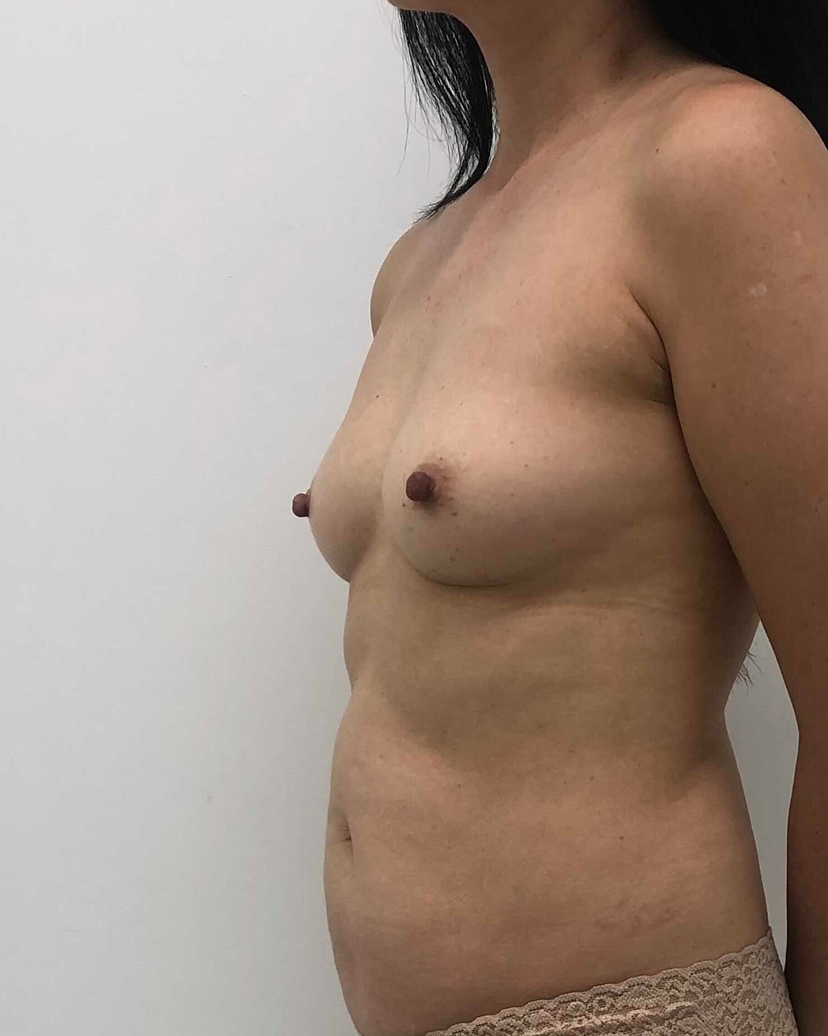Breast Augmentation Before & After