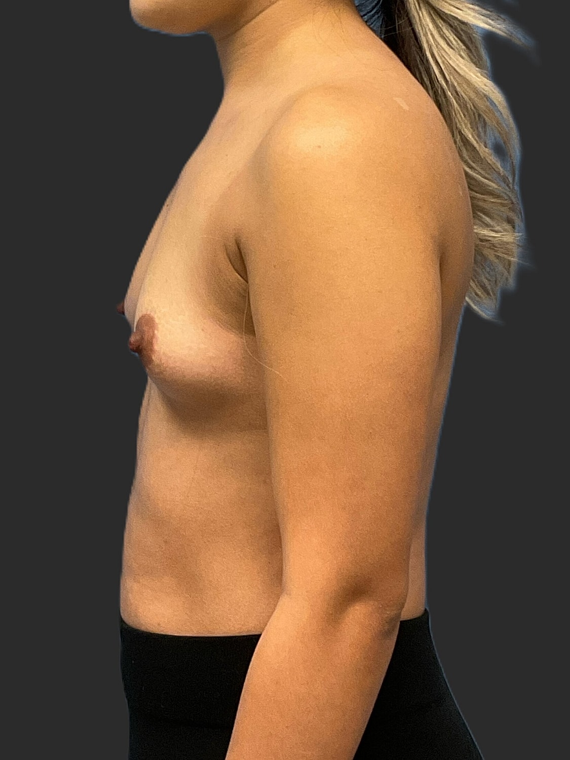 Breast Augmentation Before & After