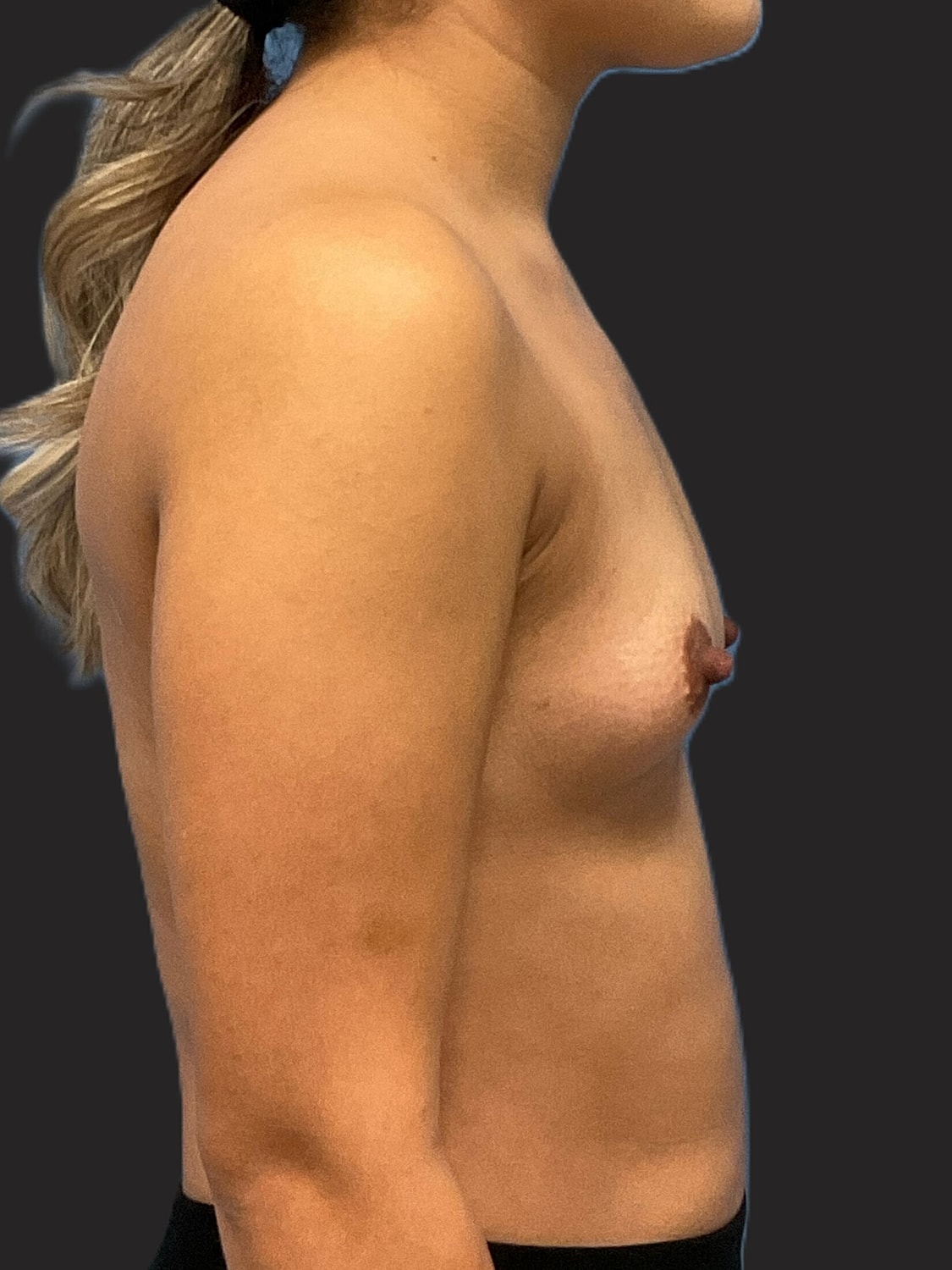 Breast Augmentation Before & After