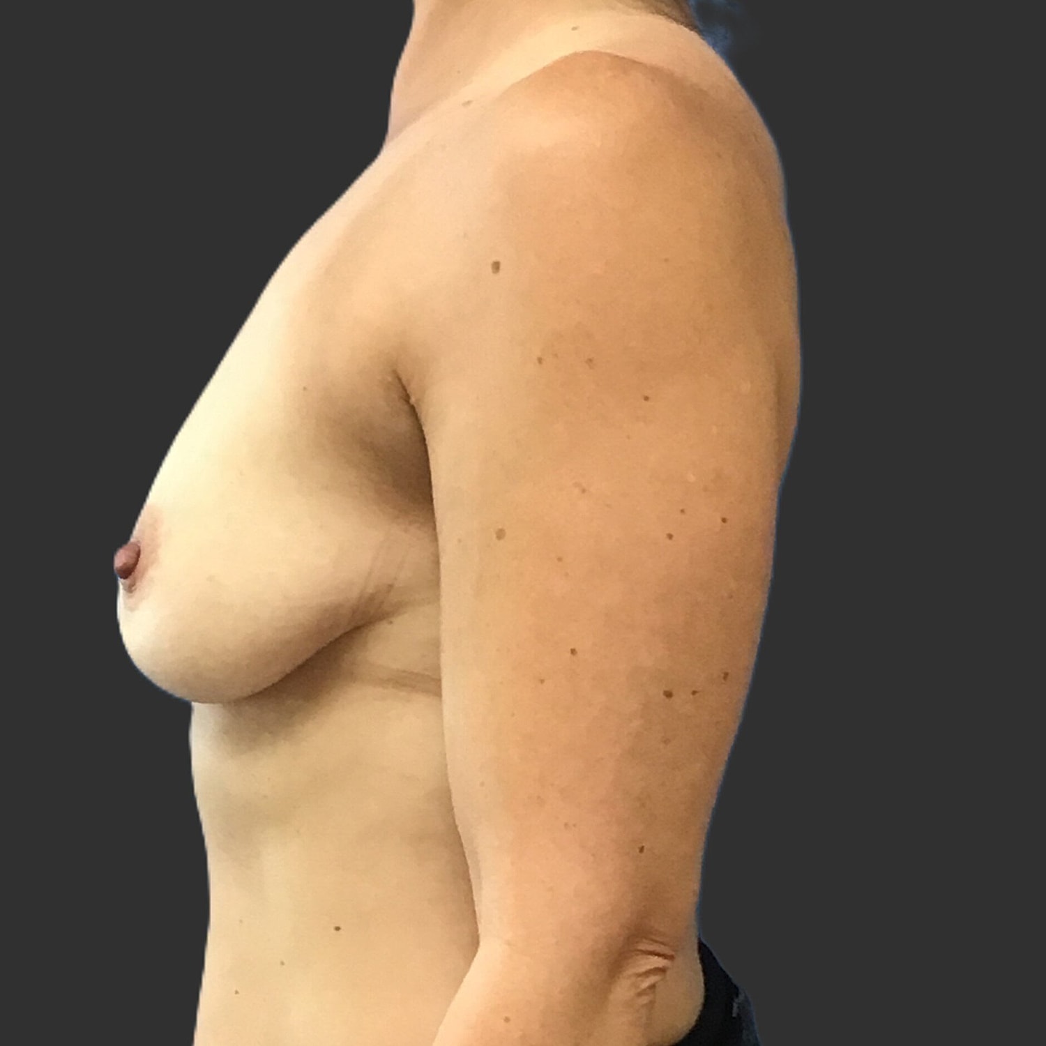 Breast Augmentation Before & After