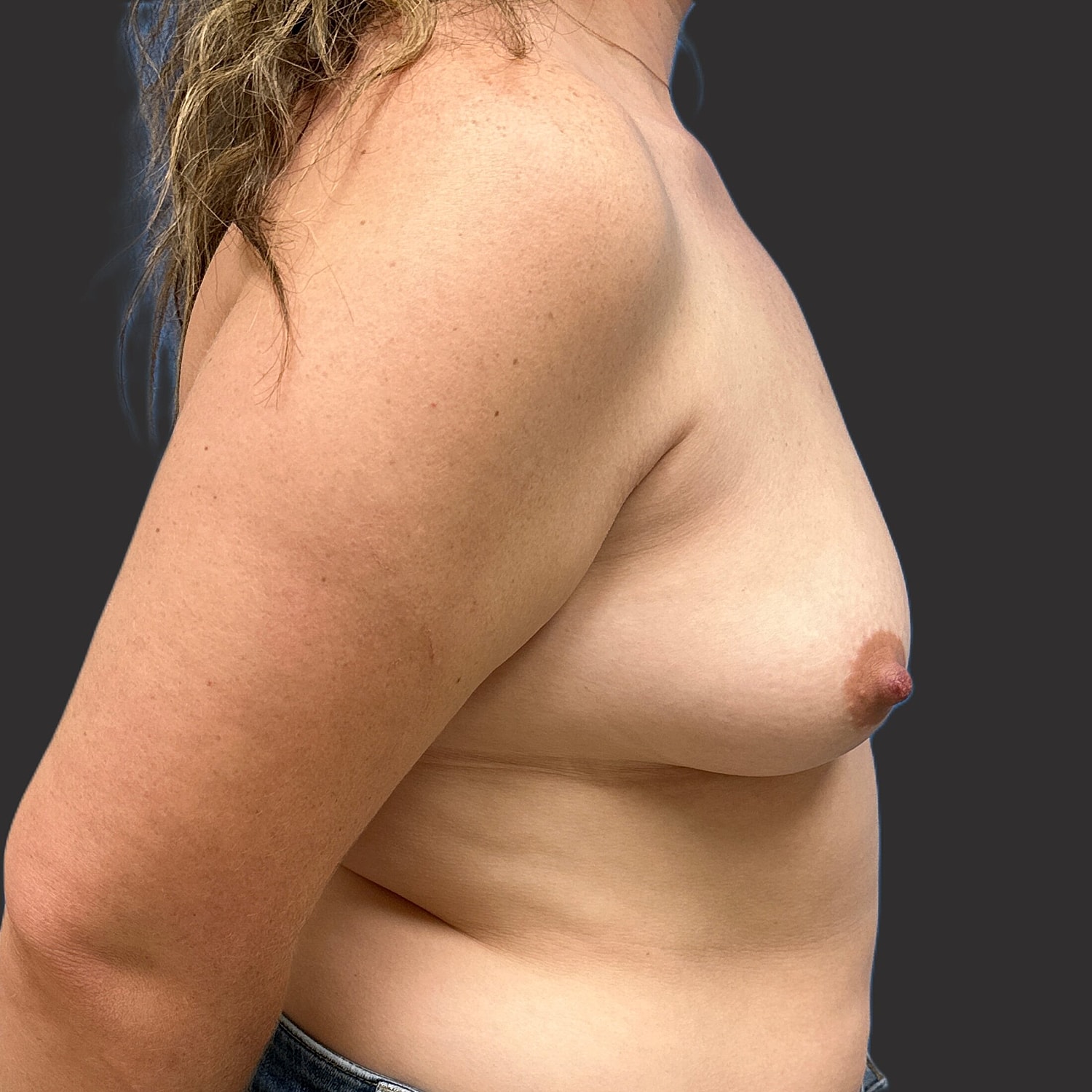 Breast Augmentation Before & After