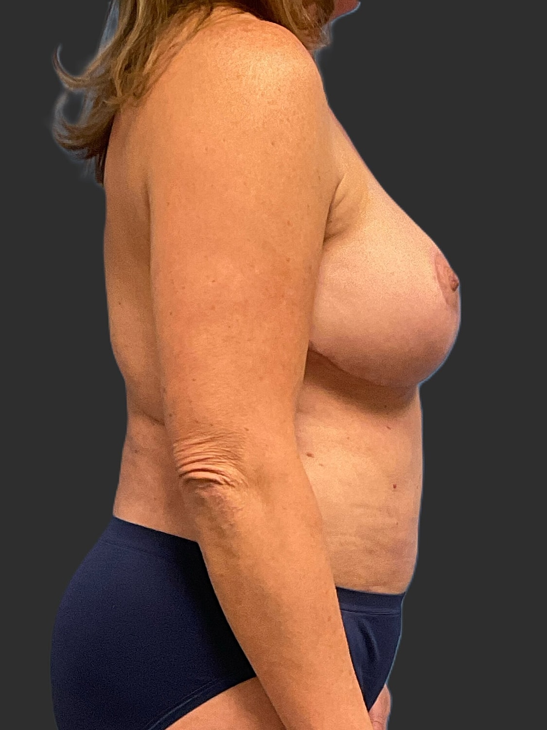 Breast Reduction Revision Before & After