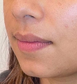 Facial Fillers Before & After