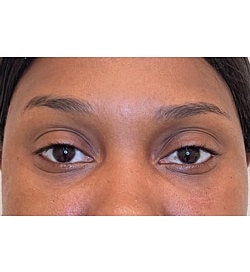 Facial Fillers Before & After