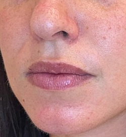 Facial Fillers Before & After