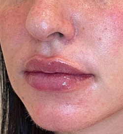 Facial Fillers Before & After