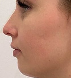 Facial Fillers Before & After
