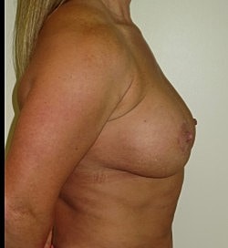 Breast Augmentation Revision Before & After
