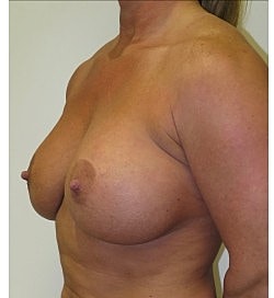 Breast Augmentation Revision Before & After