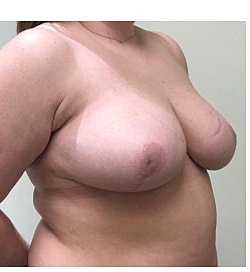 Breast Reduction Before & After