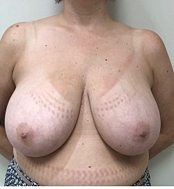 Breast Reduction Before & After