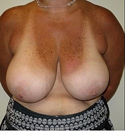Breast Reduction Before & After