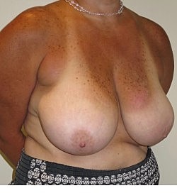 Breast Reduction Before & After