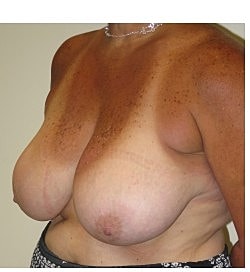 Breast Reduction Before & After