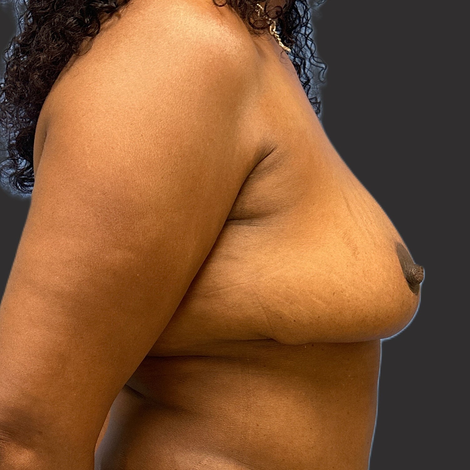 Breast Reduction Before & After