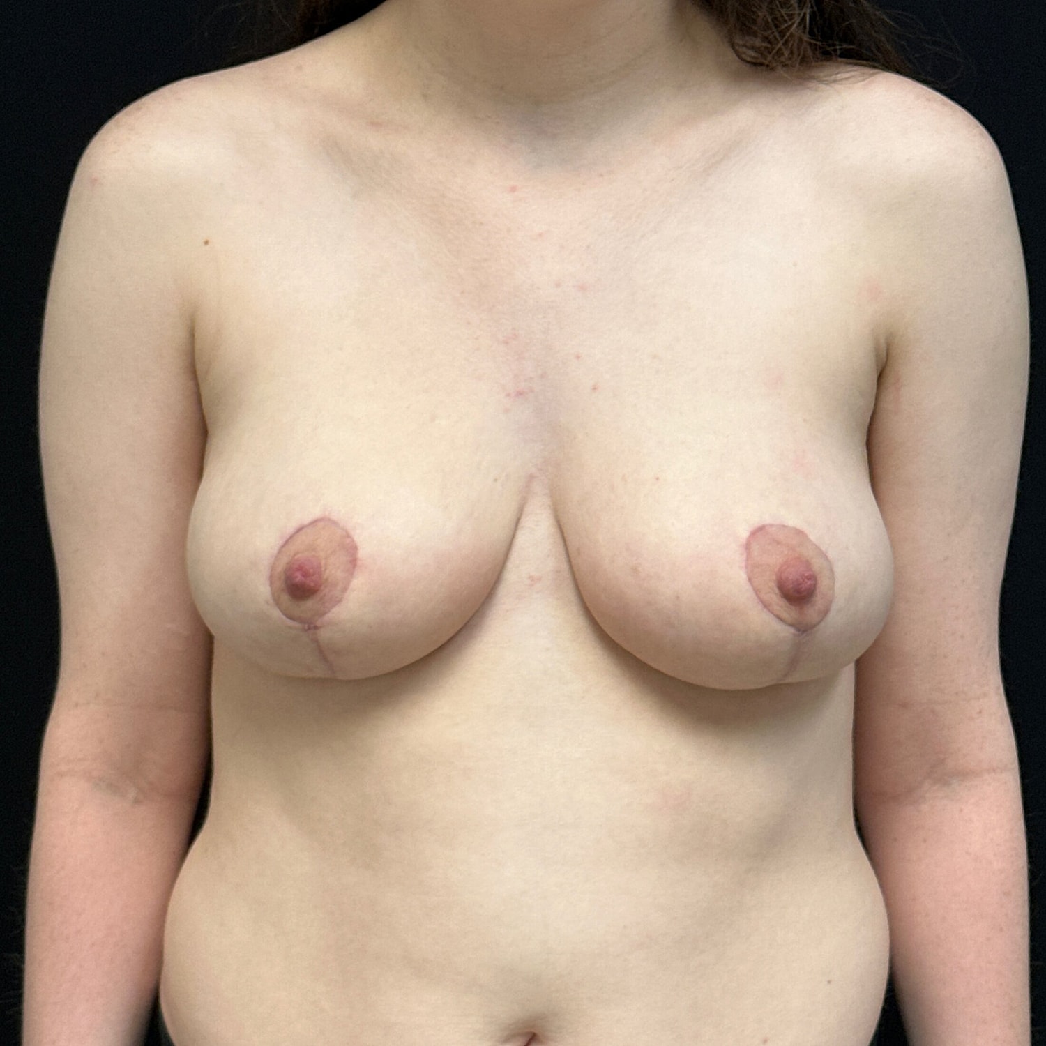 Breast Reduction Before & After