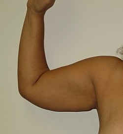 Arm Lift Before & After