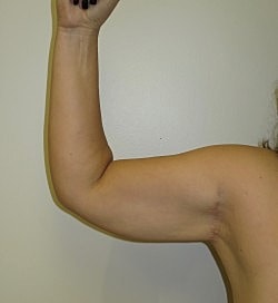 Arm Lift Before & After