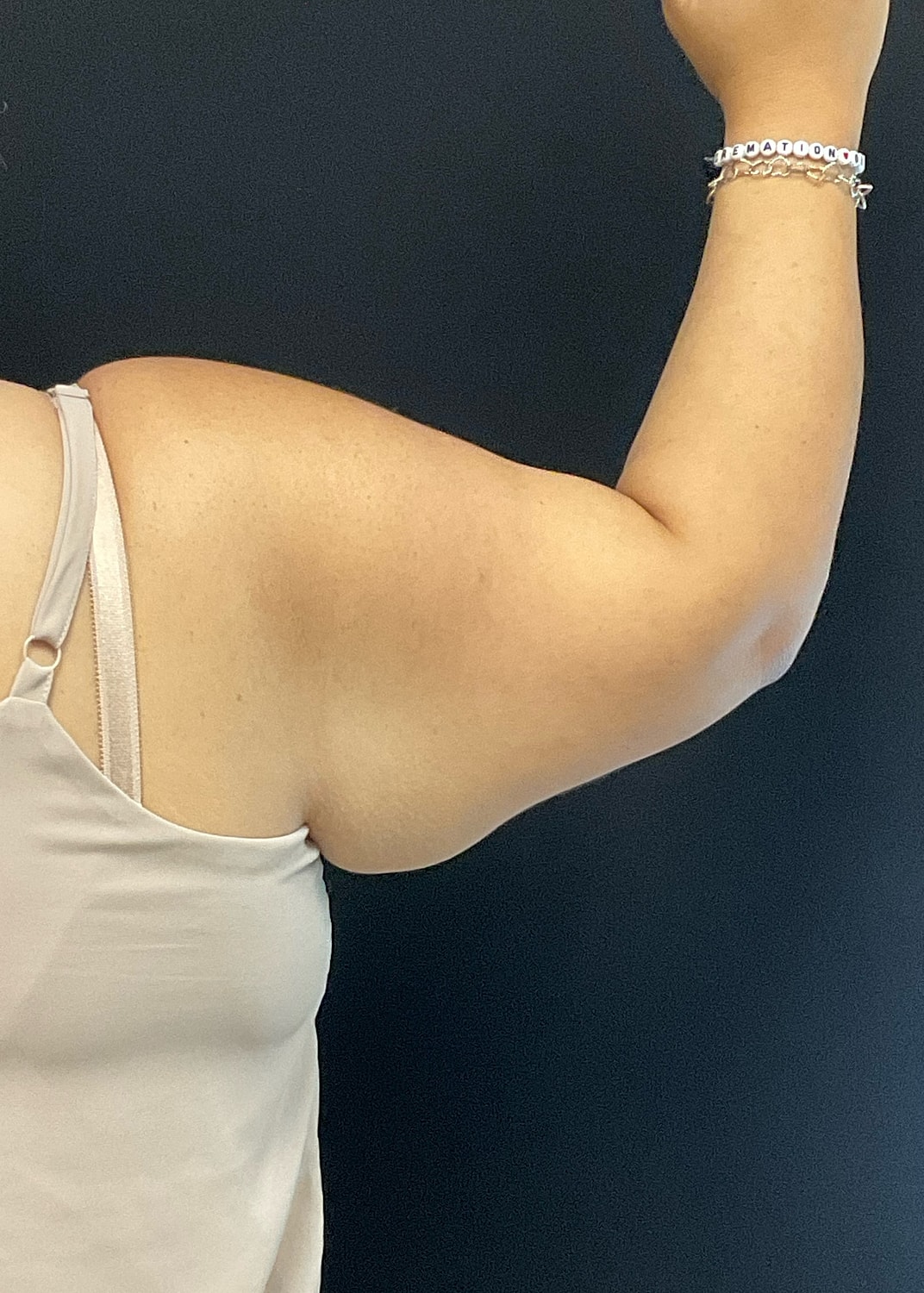 Arm Lift Before & After