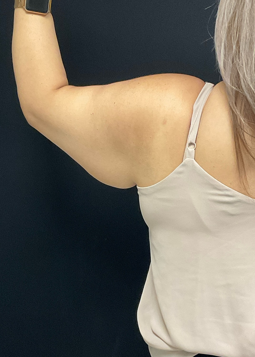 Arm Lift Before & After