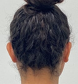 Otoplasty Before & After