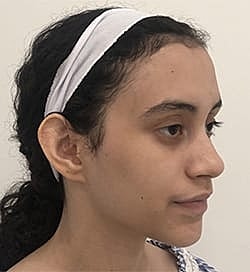 Otoplasty Before & After